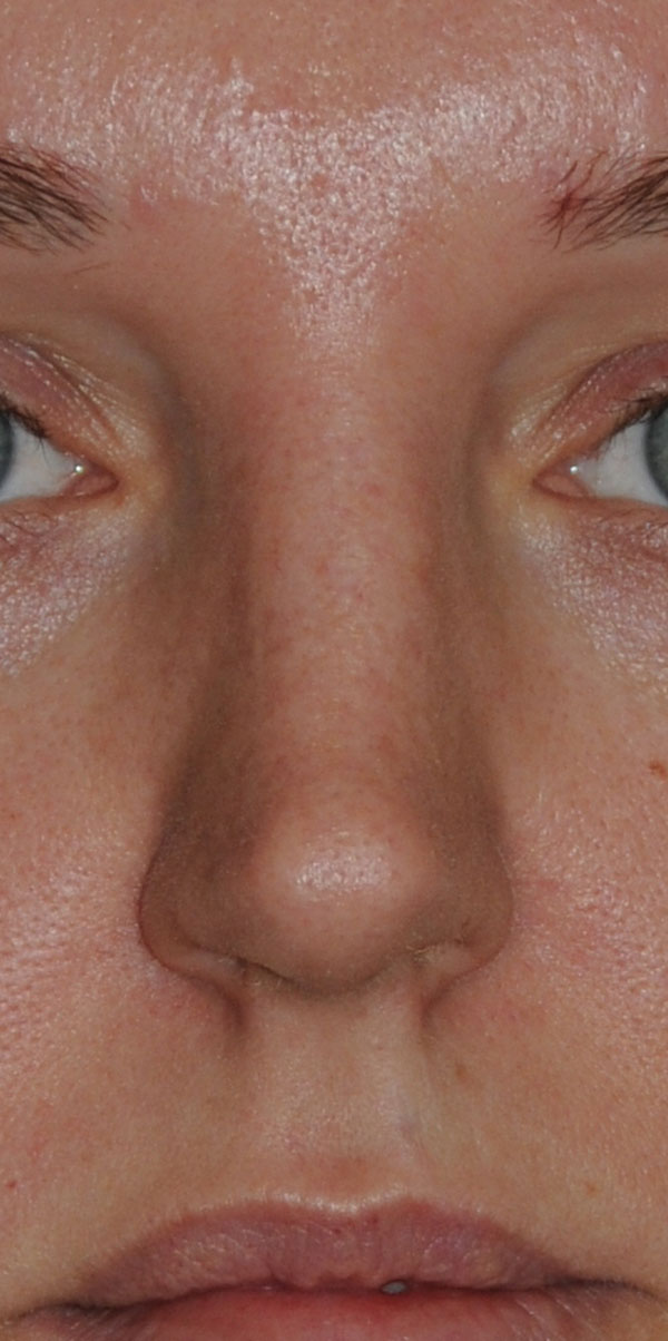 Rhinoplasty for this Overly Projected, Nasal Tip and Bridge, Large Nose, and Bulbous Nasal Tip Before View