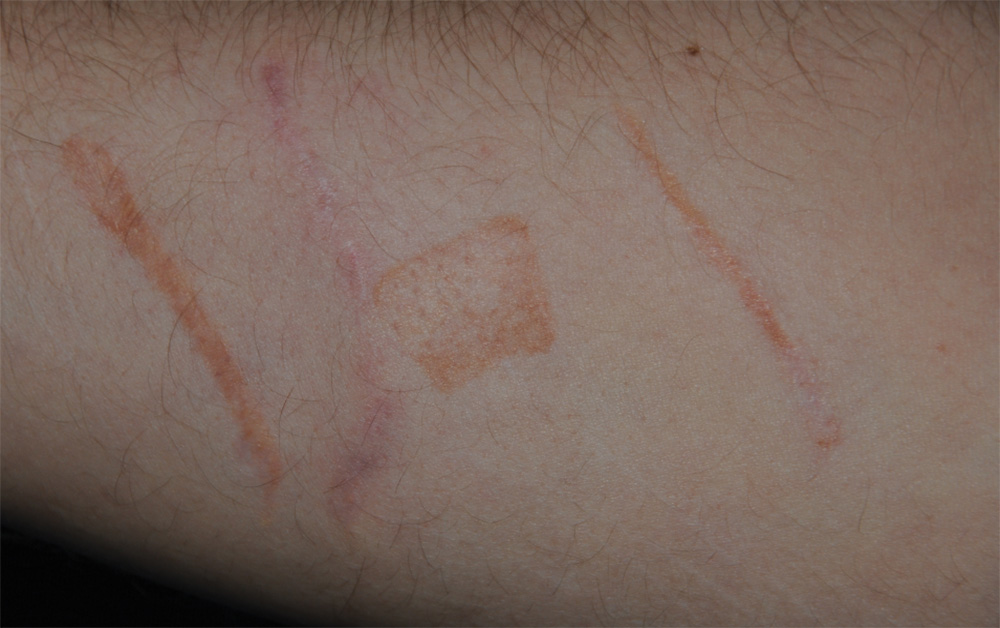 Self Harm Injury Scar Treatment After Image Demonstrating the Differences Between Excision (Cutting the Scar Out) and co2 Lasering