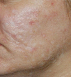 Acne Box Scar Treatment Seattle Bellevue