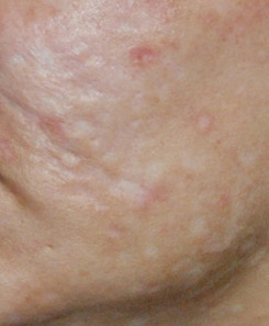 Depressed White Acne Scar Treatment Seattle Bellevue