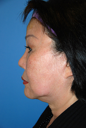 Neck lift recovery bellevue seattle