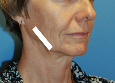 Facelift swelling