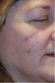 Linear Depressed Acne Scars