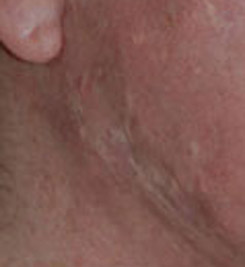 white acne scars on chest