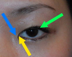 medial epicanthal fold epicanthoplasty anatomy