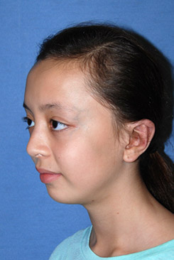 Cup Lop Constricted Ear After Otoplasty Oblique