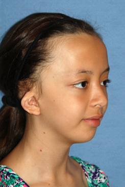 Cup Lop Constricted Ear Before Otoplasty Right Oblique